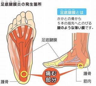 足底筋膜炎.jpg